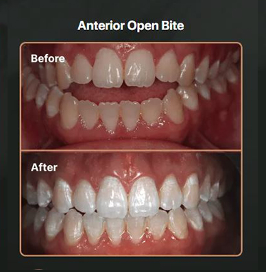 Anterior-Open-Bite