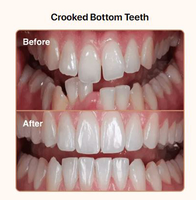 Crooked-Bottom-Teeth-2