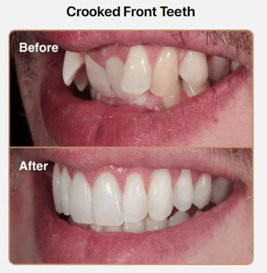 Crooked-Front-Teeth