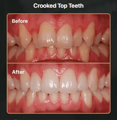 Crooked-Top-Teeth