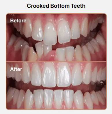 crooked-bottom-teeth