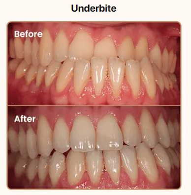 underbite